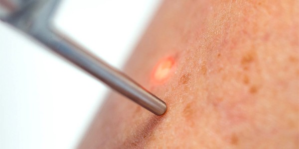 Détatouage Laser