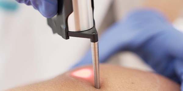 Épilation Laser Clarity II : Alexandrite / Nd :Yag